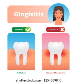 Gingivitis Vector Illustration. Medical Oral Mouth Illness Symptoms Example. Compared Healthy And Tooth With Inflammation. Isolated Anatomy Disease Diagnostics. State Before Periodontitis With Biofilm