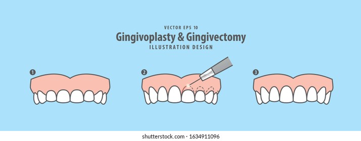 Gingivoplasty & Gingivectomy step (upper) electrosurgery cut gum off illustration vector on blue background. Dental concept.