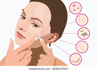 girl with acne and pimple in vector illustration. Awkward and embarrasing moments with face skin care. Type of pimples