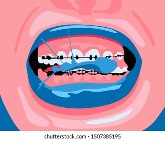 
girl with braces chews gum