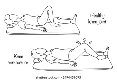 Una niña con una rodilla completamente flexionada y una niña con una amplitud de movimiento limitada de la articulación de la rodilla. Contractura de rodilla. 