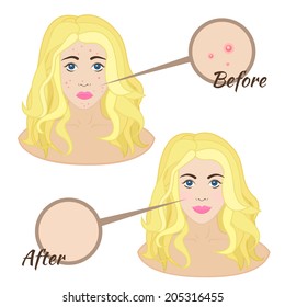 Girl face with acne, skin acne clear skin before and after