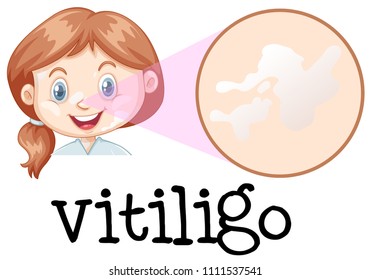 A Girl Face with Vitiligo illustration