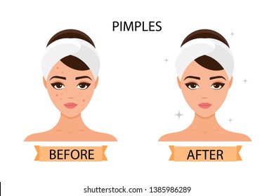 Girl has pimples on her face. Before and after. Concept of skincare, pure and healthy skin. Vector illustration.