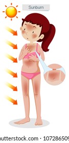 A Girl Having Sunburn and Tan Line illustration