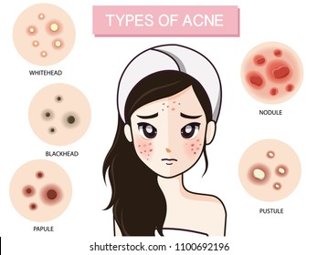 
The girl looks worried. With the type of acne.