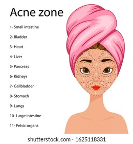 Girl with a scheme of problem areas on her face with a predisposition to acne. Cartoon style. Vector illustration