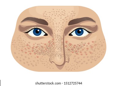 Girl with skin problems. Acne and freckles