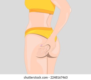 The girl stretches the skin on her leg, shows fat deposits and cellulite. The concept of weight loss and healthy lifestyle.