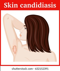 Girl with symptoms of skin candidiasis in the armpits