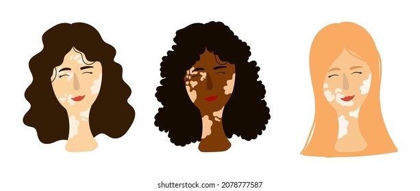 Girls with vitiligo. Feminine power.