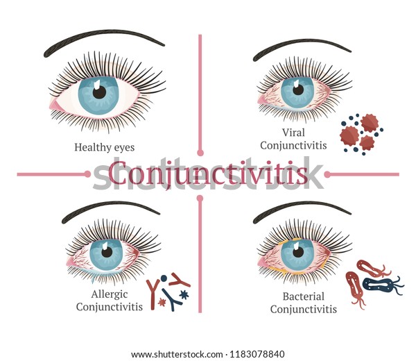 Glaucoma Chronic Eye Pathology Eye Disease Stock Vector Royalty Free 1183078840