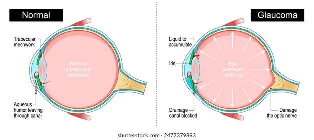 Glaucoma. Sección transversal de un globo ocular humano. Presión intraocular. Pérdida de visión. Anatomía ocular. Diagrama para educación y uso médico. Ilustración vectorial