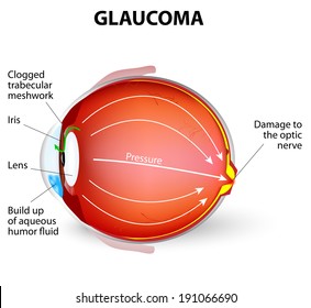 Glaucoma is an eye disease and a leading cause of blindness. The optic nerve is injured. The intra-ocular pressure is increased