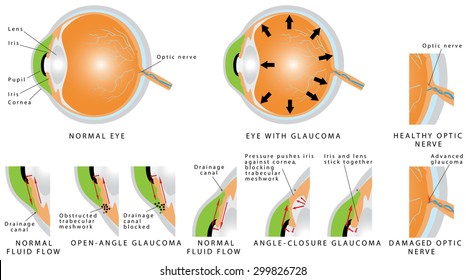 Glaucoma is an eye disease and a leading cause of blindness. Open - angle glaucoma. Angle - closure glaucoma. The optic nerve is injured. The intra-ocular pressure is increased. Stages of glaucoma