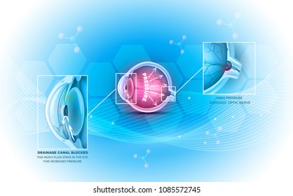 Glaucoma the eye disease on a beautiful abstract light blue background 