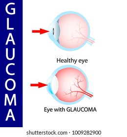 Glaucoma eye,  pressure,  optic,  nerve,  blindness,  glaucoma,