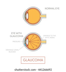 Glaucoma eye, vector. Human eye disorder