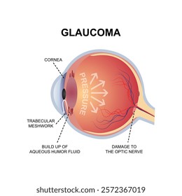 glaucoma eyes anatomy vector design