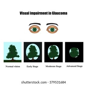 Glaucoma. The field of vision in glaucoma.  Infographics. Vector illustration on isolated background