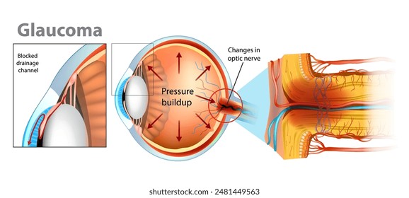 El glaucoma es un grupo de enfermedades oculares que causan daño al nervio óptico. Presión intraocular en la parte posterior del ojo