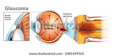 Glaucoma is a group of eye diseases that lead to damage of the optic nerve. Intraocular pressure in the back of the eye