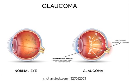 Glaucoma and healthy eye detailed structure.