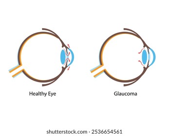 Glaucoma. Pressão intraocular aumentada, nervo óptico danificado, perda de visão. Ilustração de doença ocular humana