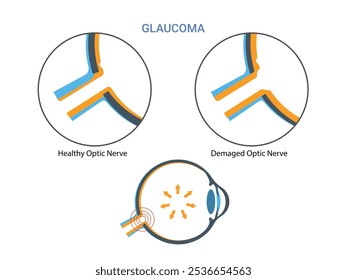 Glaucoma. Pressão intraocular aumentada, nervo óptico danificado, perda de visão. Doença ocular humana