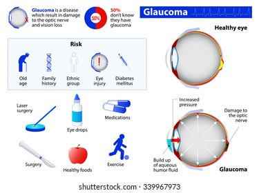 Glaucoma. Medical Infographic set with icons and other elements. medical symbols for design