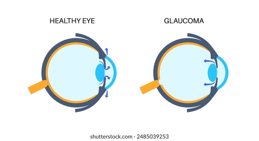 Glaucoma poster. Increased intraocular pressure, damaged optic nerve, vision loss. Blurry vision, deterioration of eyesight, halos around lights or blindness. Human eye disease vector illustration.