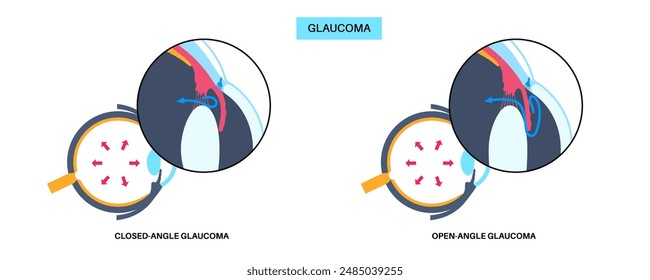 Glaucoma poster. Increased intraocular pressure, damaged optic nerve, vision loss. Blurry vision, deterioration of eyesight, halos around lights or blindness. Human eye disease vector illustration.