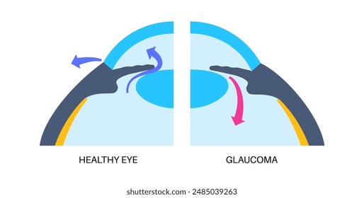 Glaucoma poster. Increased intraocular pressure, damaged optic nerve, vision loss. Blurry vision, deterioration of eyesight, halos around lights or blindness. Human eye disease vector illustration.