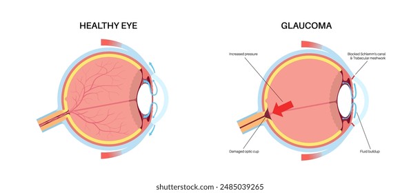 Glaucoma poster. Increased intraocular pressure, damaged optic nerve, vision loss. Blurry vision, deterioration of eyesight, halos around lights or blindness. Human eye disease vector illustration.