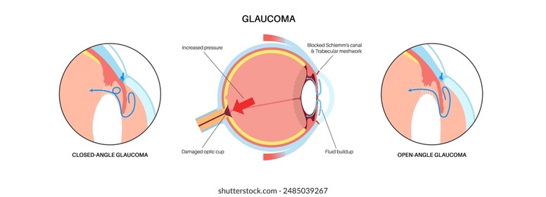 Glaucoma poster. Increased intraocular pressure, damaged optic nerve, vision loss. Blurry vision, deterioration of eyesight, halos around lights or blindness. Human eye disease vector illustration.