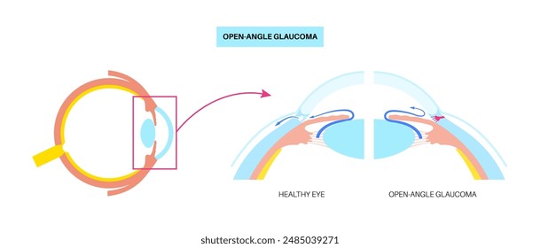 Glaucoma poster. Increased intraocular pressure, damaged optic nerve, vision loss. Blurry vision, deterioration of eyesight, halos around lights or blindness. Human eye disease vector illustration.