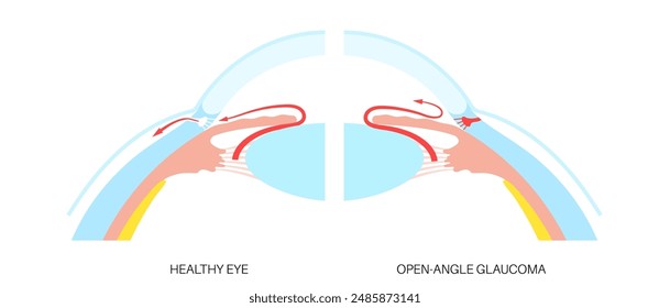 Glaucoma poster. Increased intraocular pressure, damaged optic nerve, vision loss. Blurry vision, deterioration of eyesight, halos around lights or blindness. Human eye disease vector illustration.