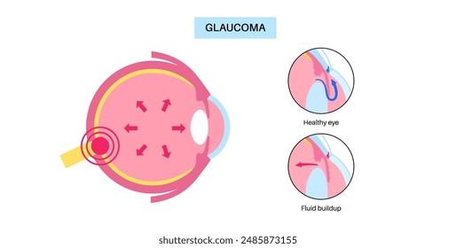 Glaucoma poster. Increased intraocular pressure, damaged optic nerve, vision loss. Blurry vision, deterioration of eyesight, halos around lights or blindness. Human eye disease vector illustration.