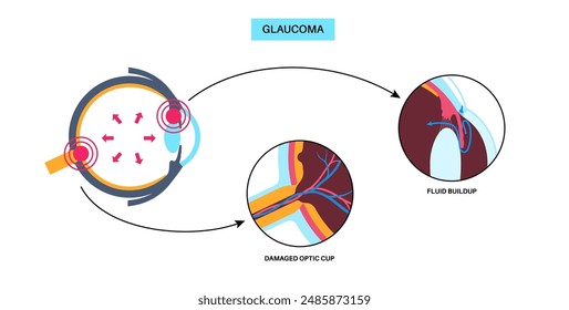 Cartel del glaucoma. Aumento de la presión intraocular, daño del nervio óptico, pérdida de visión. Visión borrosa, deterioro de la vista, halos alrededor de las luces o ceguera. Ilustración vectorial de enfermedad ocular humana.