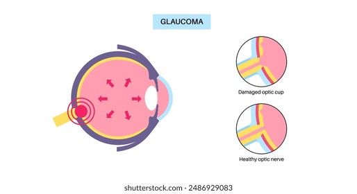 Glaucoma poster. Increased intraocular pressure, damaged optic nerve, vision loss. Blurry vision, deterioration of eyesight, halos around lights or blindness. Human eye disease vector illustration.