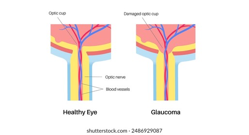 Glaucoma poster. Increased intraocular pressure, damaged optic nerve, vision loss. Blurry vision, deterioration of eyesight, halos around lights or blindness. Human eye disease vector illustration.