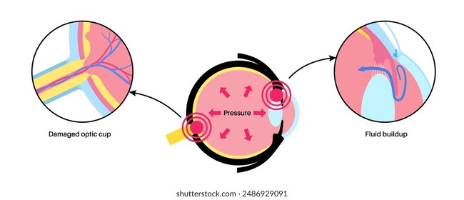 Glaucoma poster. Increased intraocular pressure, damaged optic nerve, vision loss. Blurry vision, deterioration of eyesight, halos around lights or blindness. Human eye disease vector illustration.