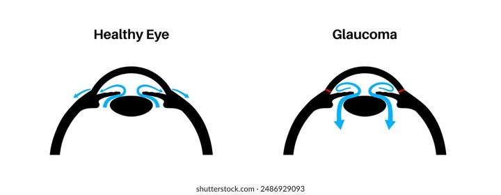 Cartel del glaucoma. Aumento de la presión intraocular, daño del nervio óptico, pérdida de visión. Visión borrosa, deterioro de la vista, halos alrededor de las luces o ceguera. Ilustración vectorial de enfermedad ocular humana.
