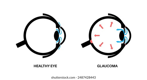 Glaucoma poster. Increased intraocular pressure, damaged optic nerve, vision loss. Blurry vision, deterioration of eyesight, halos around lights or blindness. Human eye disease vector illustration.