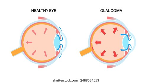 Glaukom-Poster. Erhöhter Augeninnendruck, geschädigter Sehnerv, Sehverlust. Verschwommenes Sehen, Verschlechterung des Sehvermögens, Lichthöfe um Lichtquellen oder Blindheit. In: Human Eye Disease Vektorillustration.