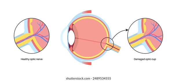 Glaukom-Poster. Erhöhter Augeninnendruck, geschädigter Sehnerv, Sehverlust. Verschwommenes Sehen, Verschlechterung des Sehvermögens, Lichthöfe um Lichtquellen oder Blindheit. In: Human Eye Disease Vektorillustration.