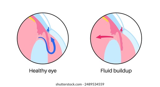 Glaucoma poster. Increased intraocular pressure, damaged optic nerve, vision loss. Blurry vision, deterioration of eyesight, halos around lights or blindness. Human eye disease vector illustration.