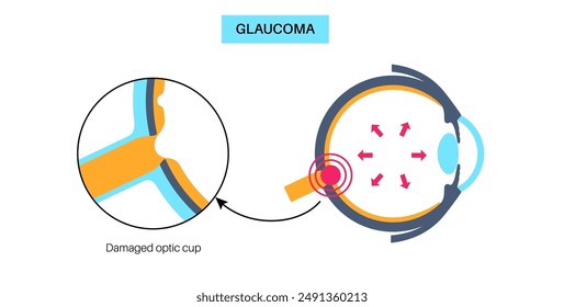 Glaucoma poster. Increased intraocular pressure, damaged optic nerve, vision loss. Blurry vision, deterioration of eyesight, halos around lights or blindness. Human eye disease vector illustration.