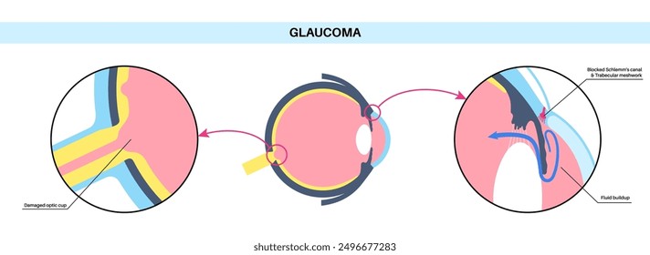 Glaucoma poster. Increased intraocular pressure, damaged optic nerve, vision loss. Blurry vision, deterioration of eyesight, halos around lights or blindness. Human eye disease vector illustration.