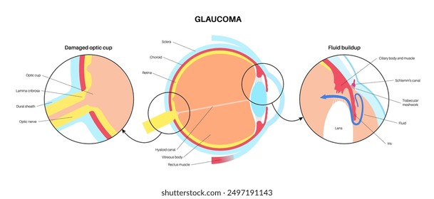 Glaukomposter. Erhöhter Augeninnendruck, beschädigter Sehnerv, Sehverlust. Verschwommenes Sehen, Verschlechterung des Sehvermögens, Heiligenschein um Lichter oder Blindheit. Vektorgrafik der menschlichen Augenerkrankung.